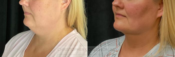 Submental Liposuction Case 301 Before & After Left Oblique | Boston, MA | Christopher J. Davidson, MD