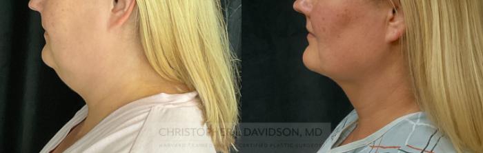 Submental Liposuction Case 301 Before & After Left Side | Boston, MA | Christopher J. Davidson, MD