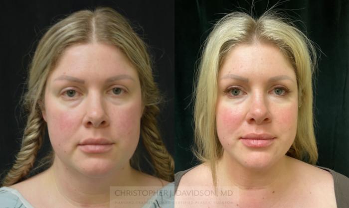 Submental Liposuction Case 316 Before & After Front | Boston, MA | Christopher J. Davidson, MD