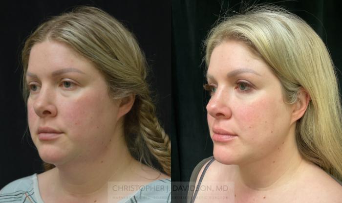 Submental Liposuction Case 316 Before & After Left Oblique | Boston, MA | Christopher J. Davidson, MD
