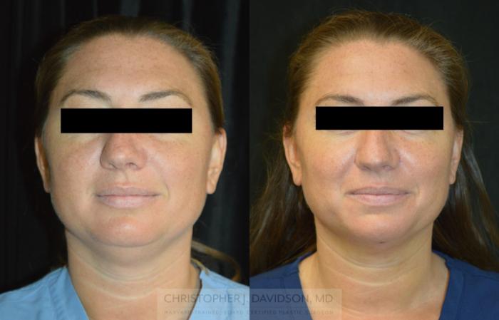 Submental Liposuction Case 317 Before & After Front | Boston, MA | Christopher J. Davidson, MD