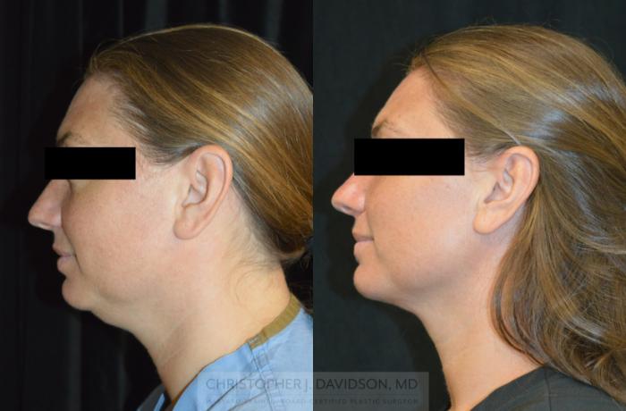 Submental Liposuction Case 317 Before & After Left Side | Boston, MA | Christopher J. Davidson, MD