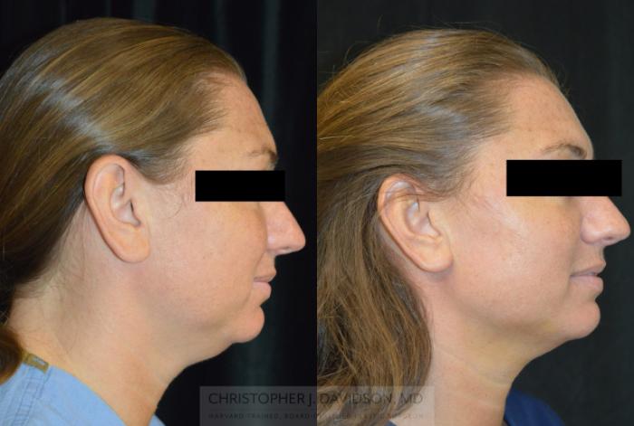 Submental Liposuction Case 317 Before & After Right Side | Boston, MA | Christopher J. Davidson, MD