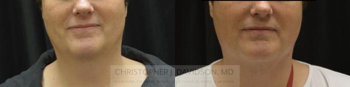 Submental Liposuction Case 327 Before & After Front | Boston, MA | Christopher J. Davidson, MD