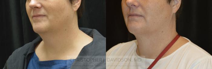 Submental Liposuction Case 327 Before & After Left Oblique | Boston, MA | Christopher J. Davidson, MD
