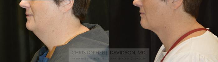 Submental Liposuction Case 327 Before & After Left Side | Boston, MA | Christopher J. Davidson, MD