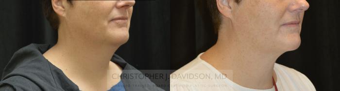 Submental Liposuction Case 327 Before & After Right Oblique | Boston, MA | Christopher J. Davidson, MD