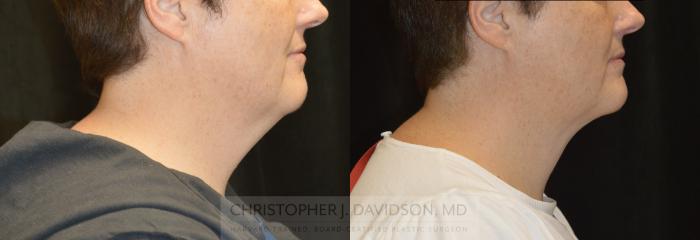 Submental Liposuction Case 327 Before & After Right Side | Boston, MA | Christopher J. Davidson, MD