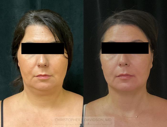 Submental Liposuction Case 345 Before & After Front | Boston, MA | Christopher J. Davidson, MD