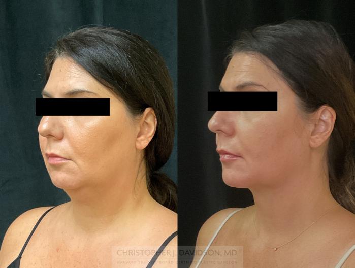 Submental Liposuction Case 345 Before & After Left Oblique | Boston, MA | Christopher J. Davidson, MD