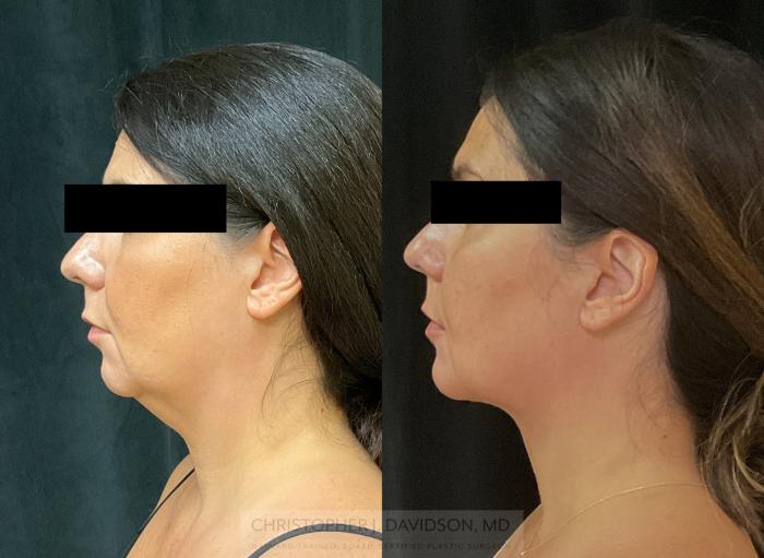 Submental Liposuction Case 345 Before & After Left Side | Boston, MA | Christopher J. Davidson, MD