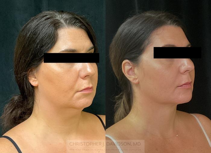 Submental Liposuction Case 345 Before & After Right Oblique | Boston, MA | Christopher J. Davidson, MD