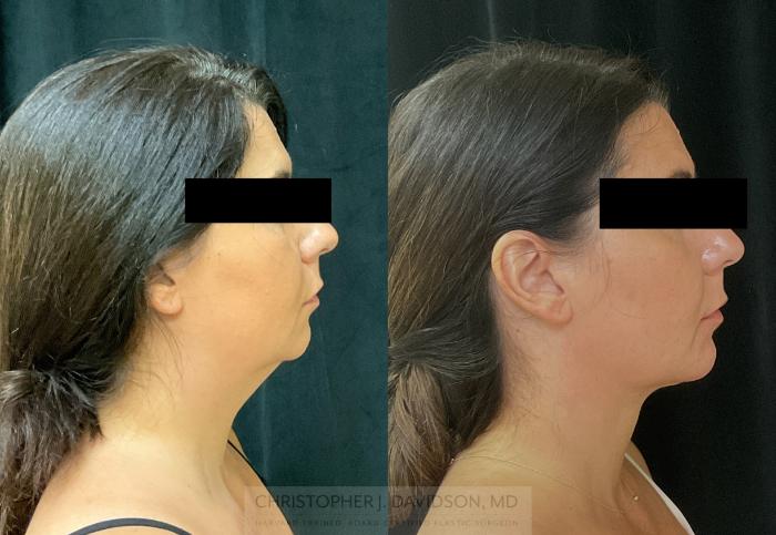 Submental Liposuction Case 345 Before & After Right Side | Boston, MA | Christopher J. Davidson, MD