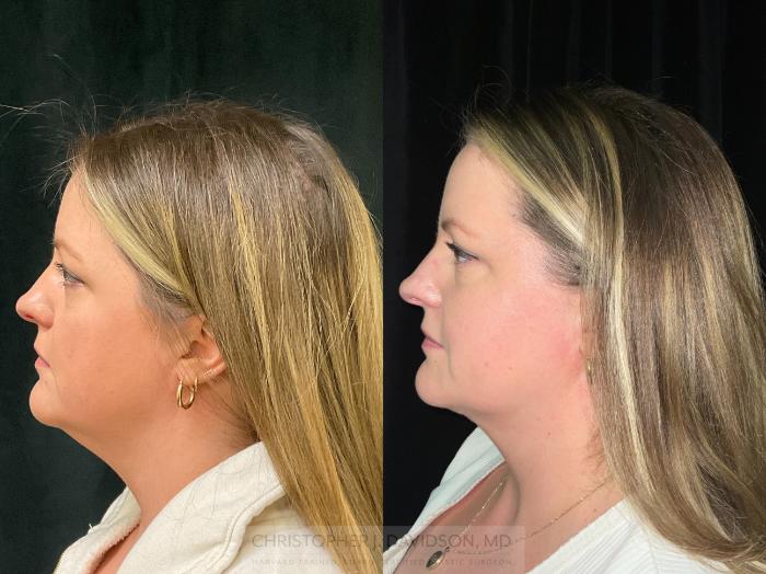 Submental Liposuction Case 363 Before & After Left Side | Boston, MA | Christopher J. Davidson, MD