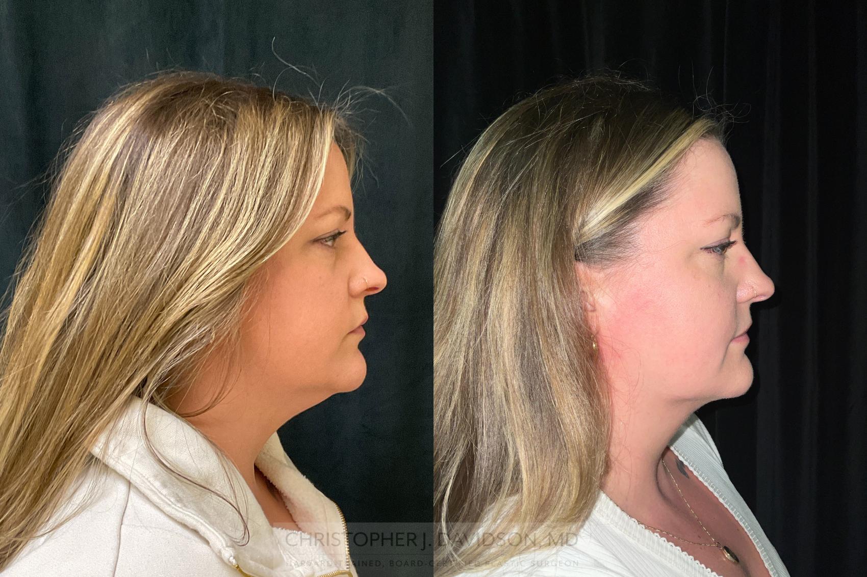 Submental Liposuction Case 363 Before & After Right Side | Boston, MA | Christopher J. Davidson, MD