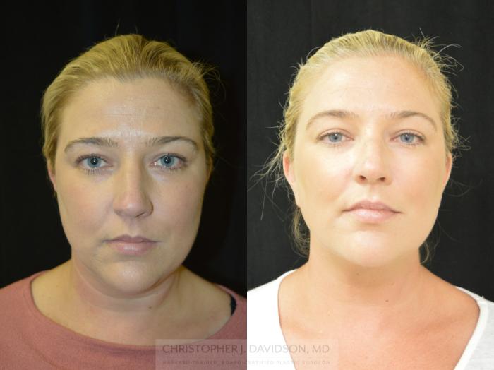 Submental Liposuction Case 403 Before & After Front | Boston, MA | Christopher J. Davidson, MD