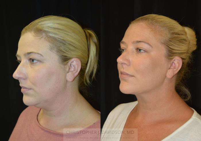 Submental Liposuction Case 403 Before & After Left Oblique | Boston, MA | Christopher J. Davidson, MD