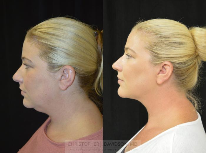 Submental Liposuction Case 403 Before & After Left Side | Boston, MA | Christopher J. Davidson, MD