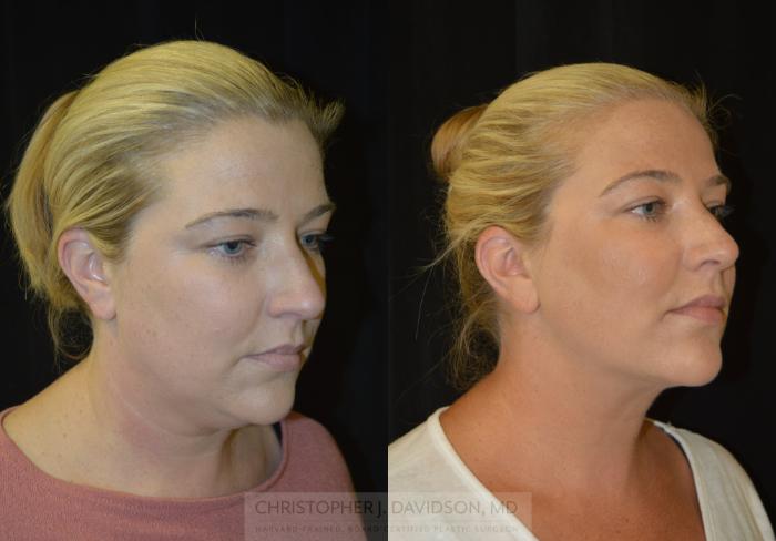 Submental Liposuction Case 403 Before & After Right Oblique | Boston, MA | Christopher J. Davidson, MD