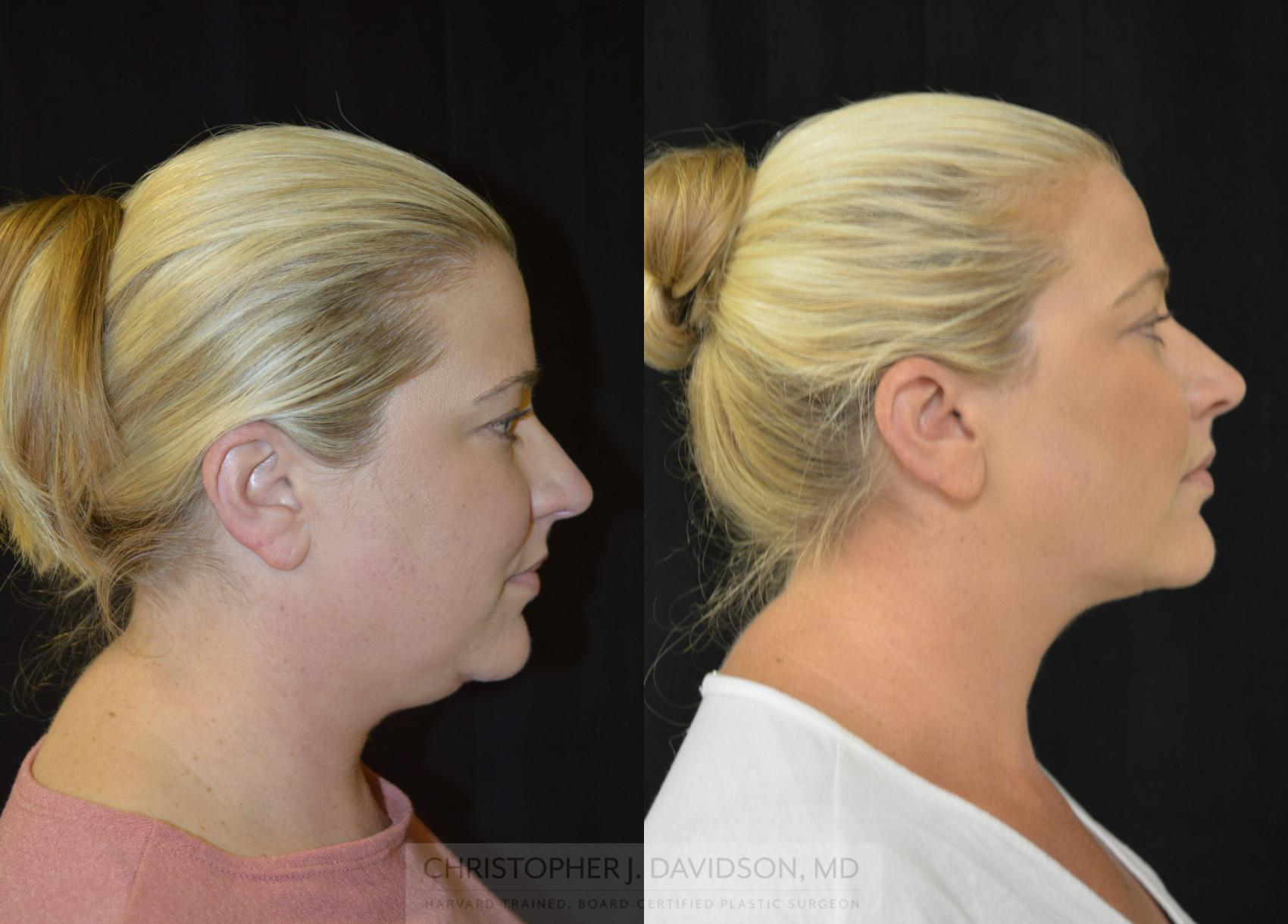 Submental Liposuction Case 403 Before & After Right Side | Boston, MA | Christopher J. Davidson, MD