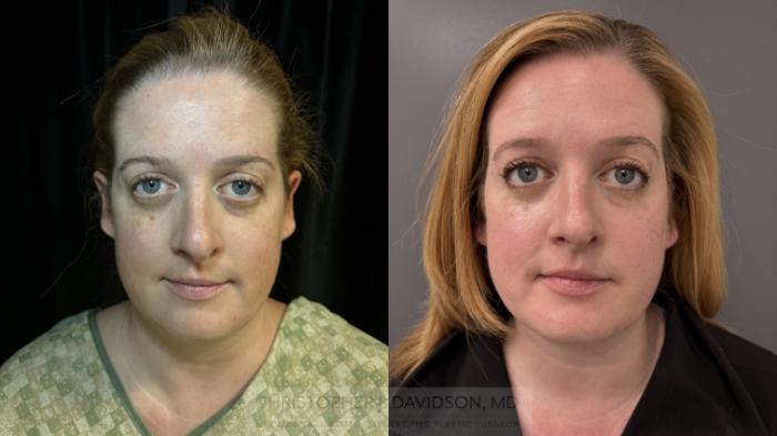 Submental Liposuction Case 422 Before & After Front | Boston, MA | Christopher J. Davidson, MD