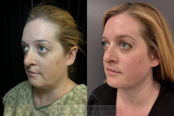 Submental Liposuction Case 422 Before & After Left Oblique | Boston, MA | Christopher J. Davidson, MD