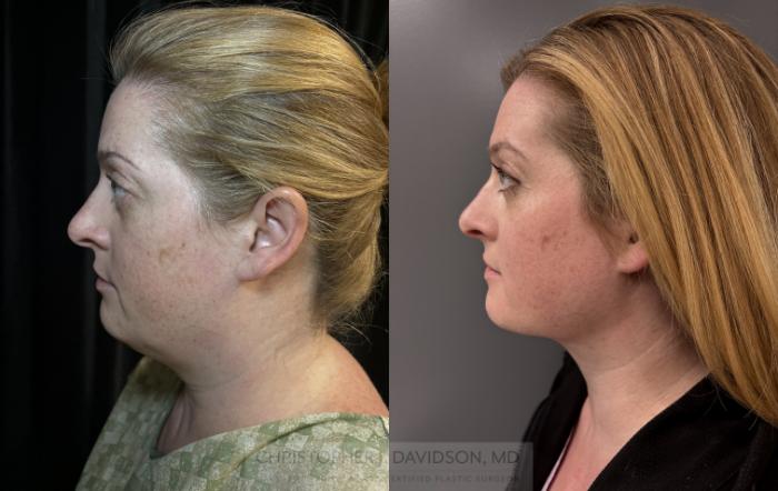 Submental Liposuction Case 422 Before & After Left Side | Boston, MA | Christopher J. Davidson, MD