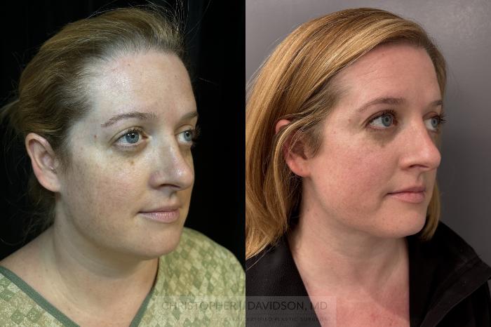 Submental Liposuction Case 422 Before & After Right Oblique | Boston, MA | Christopher J. Davidson, MD