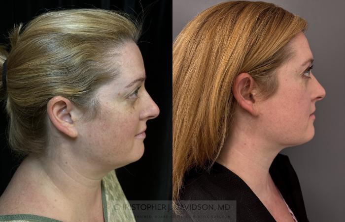 Submental Liposuction Case 422 Before & After Right Side | Boston, MA | Christopher J. Davidson, MD
