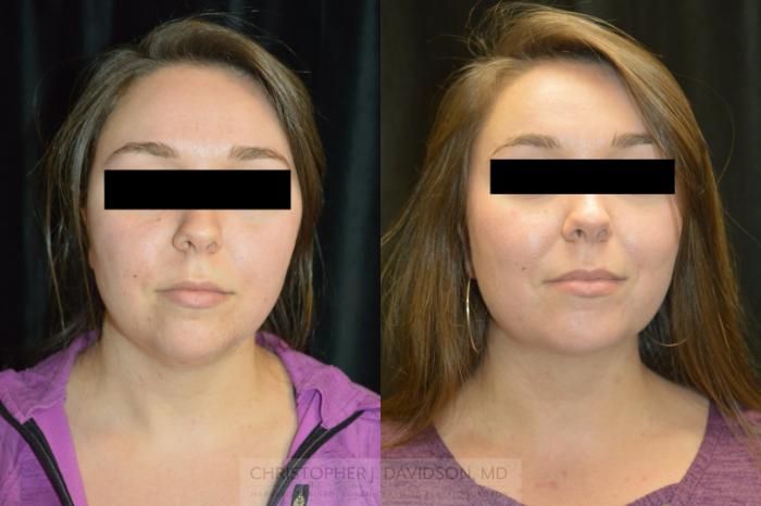 Submental Liposuction Case 447 Before & After Front | Boston, MA | Christopher J. Davidson, MD