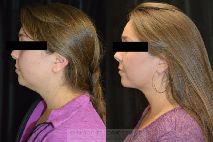 Submental Liposuction Case 447 Before & After Left Side | Boston, MA | Christopher J. Davidson, MD