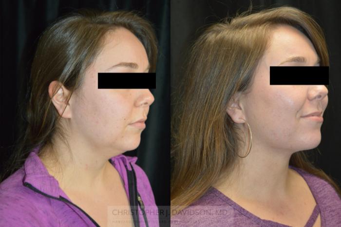 Submental Liposuction Case 447 Before & After Right Oblique | Boston, MA | Christopher J. Davidson, MD