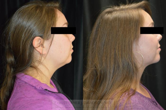 Submental Liposuction Case 447 Before & After Right Side | Boston, MA | Christopher J. Davidson, MD