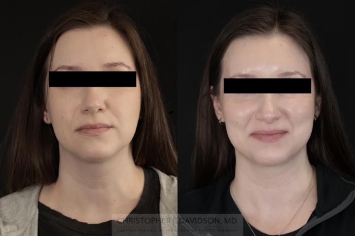 Submental Liposuction Case 477 Before & After Front | Boston, MA | Christopher J. Davidson, MD