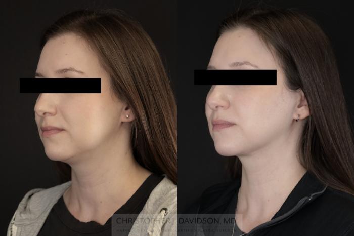 Submental Liposuction Case 477 Before & After Left Oblique | Boston, MA | Christopher J. Davidson, MD