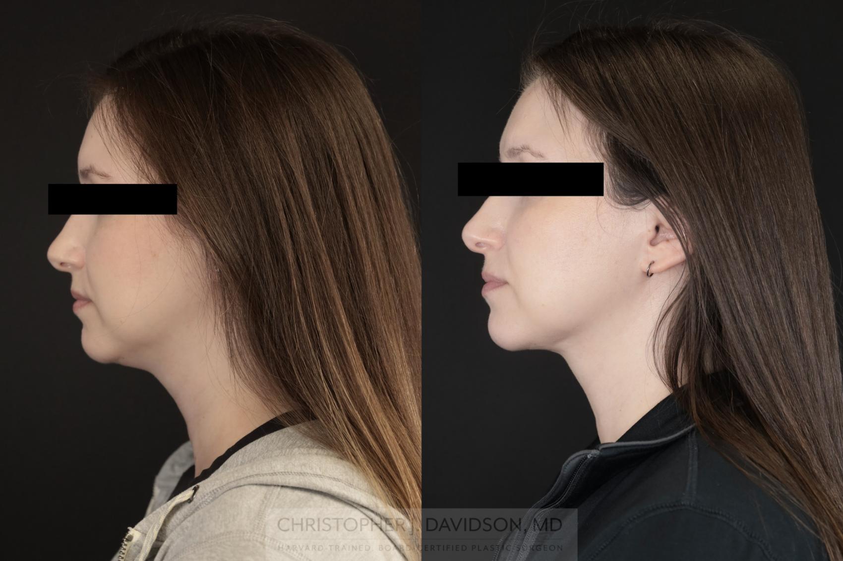 Submental Liposuction Case 477 Before & After Left Side | Boston, MA | Christopher J. Davidson, MD