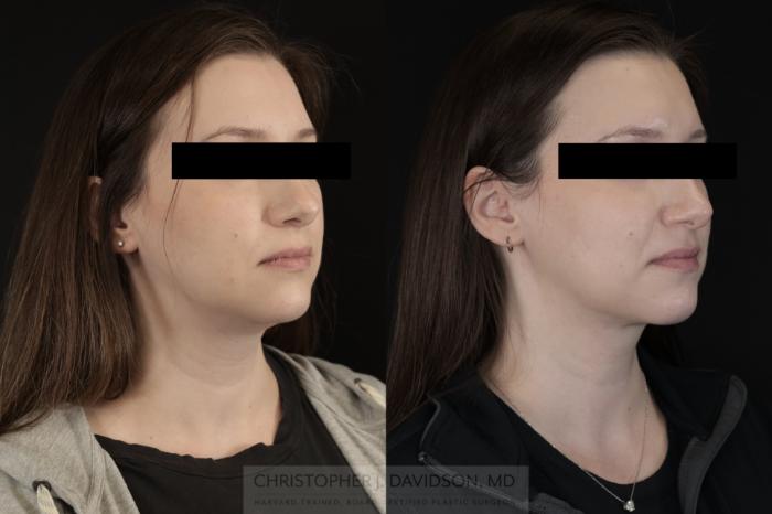 Submental Liposuction Case 477 Before & After Right Oblique | Boston, MA | Christopher J. Davidson, MD
