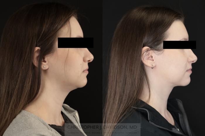 Submental Liposuction Case 477 Before & After Right Side | Boston, MA | Christopher J. Davidson, MD