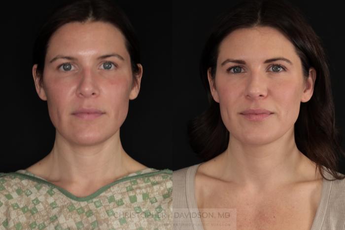 Submental Liposuction Case 479 Before & After Front | Boston, MA | Christopher J. Davidson, MD