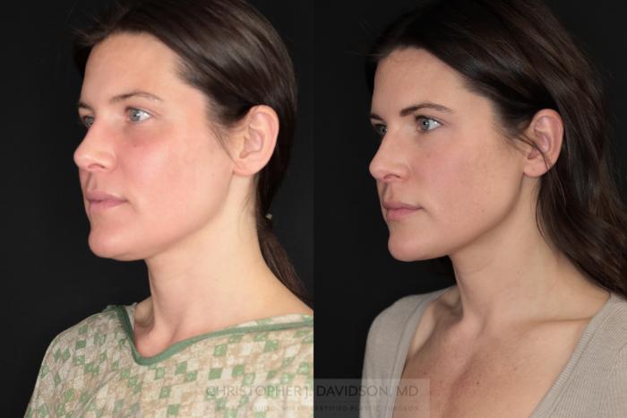 Submental Liposuction Case 479 Before & After Left Oblique | Boston, MA | Christopher J. Davidson, MD