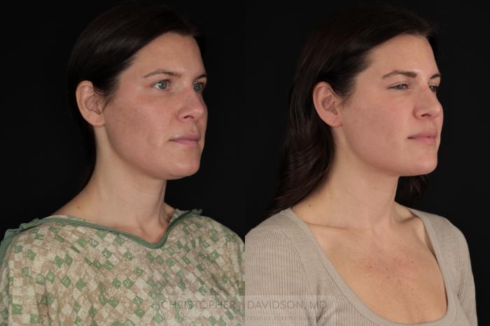Submental Liposuction Case 479 Before & After Right Oblique | Boston, MA | Christopher J. Davidson, MD