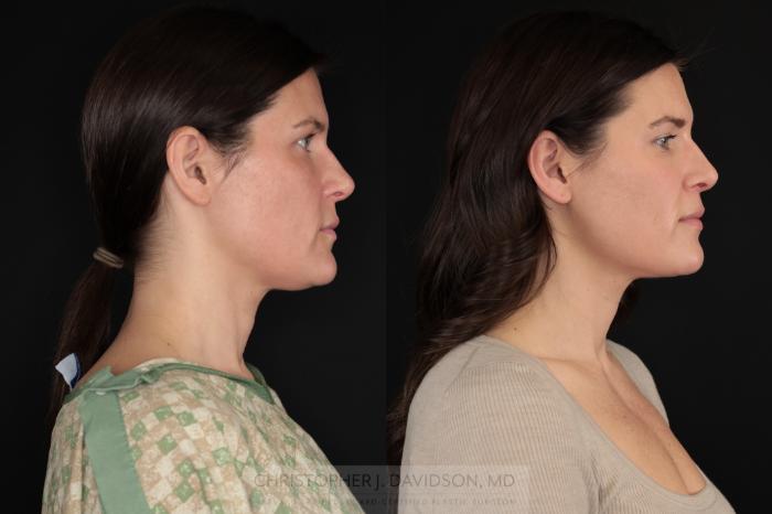 Submental Liposuction Case 479 Before & After Right Side | Boston, MA | Christopher J. Davidson, MD