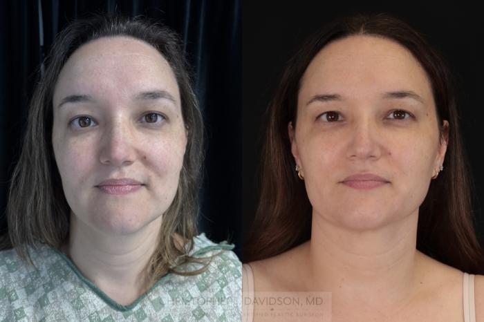 Submental Liposuction Case 484 Before & After Front | Boston, MA | Christopher J. Davidson, MD