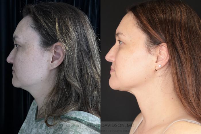 Submental Liposuction Case 484 Before & After Left Side | Boston, MA | Christopher J. Davidson, MD