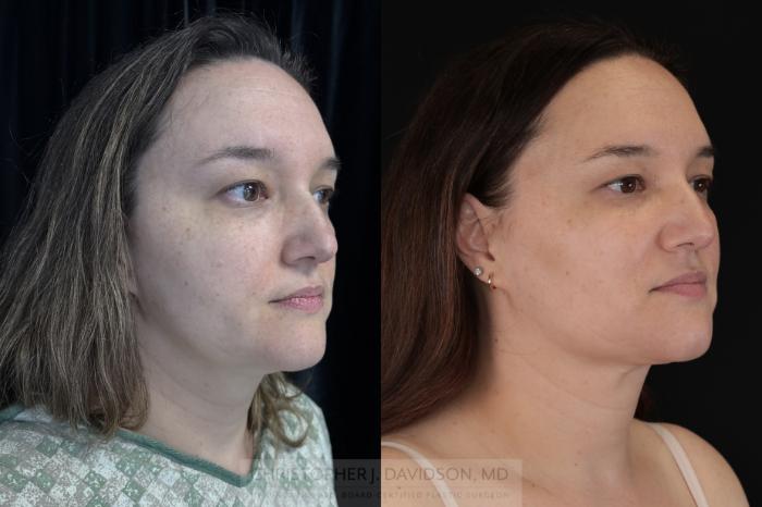 Submental Liposuction Case 484 Before & After Right Oblique | Boston, MA | Christopher J. Davidson, MD