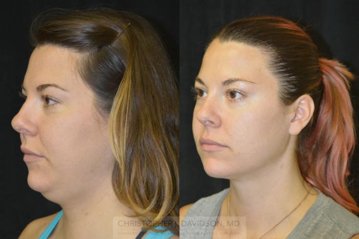 Submental Liposuction Case 97 Before & After View #3 | Boston, MA | Christopher J. Davidson, MD