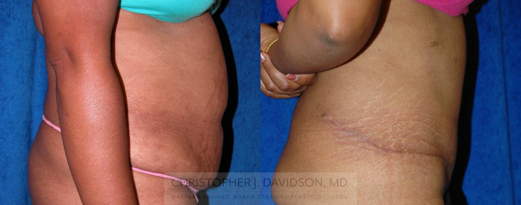 Tummy Tuck (Abdominoplasty) Case 10 Before & After View #3 | Wellesley, MA | Christopher J. Davidson, MD