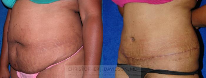 Tummy Tuck (Abdominoplasty) Case 10 Before & After View #4 | Wellesley, MA | Christopher J. Davidson, MD