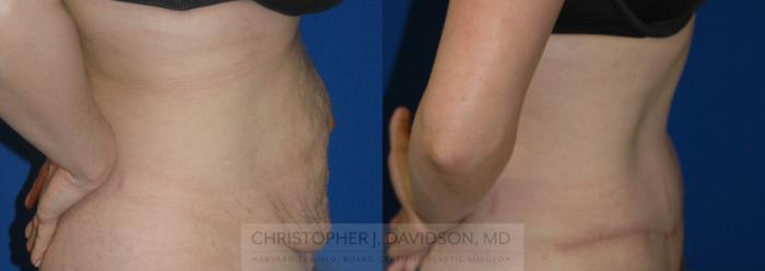 Tummy Tuck (Abdominoplasty) Case 107 Before & After View #3 | Boston, MA | Christopher J. Davidson, MD