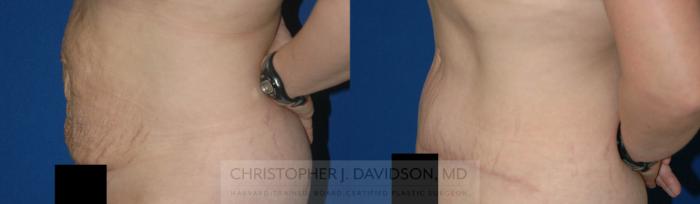 Tummy Tuck (Abdominoplasty) Case 11 Before & After Left Side | Boston, MA | Christopher J. Davidson, MD